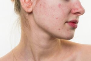 9 cách phục hồi da mặt bị hư tổn tại nhà cực hiệu quả